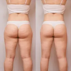 Reducción & Moldeo corporal